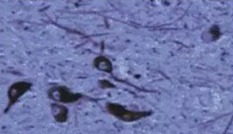 正凡人：：黑质神经元保存