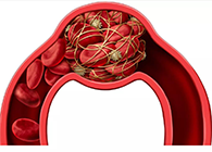 令人“闻风丧胆”的脑卒中发明治疗新机制！！