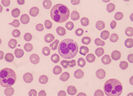 一种神秘颗粒被发明了！！！它能否成为败血症早筛标记物？