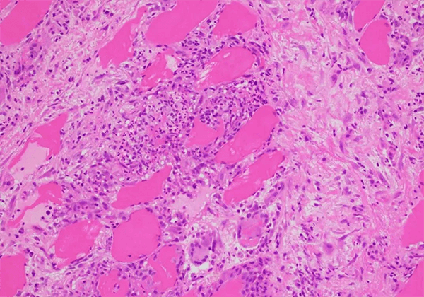 【EBET易博助力】治疗结节病的KBMAB-16获FDA批准临床